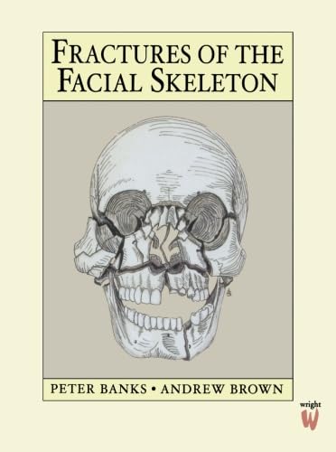 Fractures of the Facial Skeleton