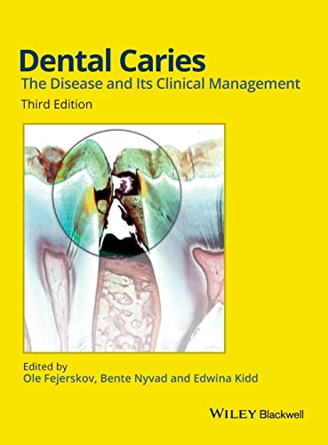 Dental Caries: The Disease and its Clinical Management