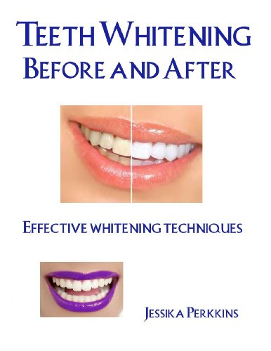 Teeth Whitening Before and After: Effective whitening techniques