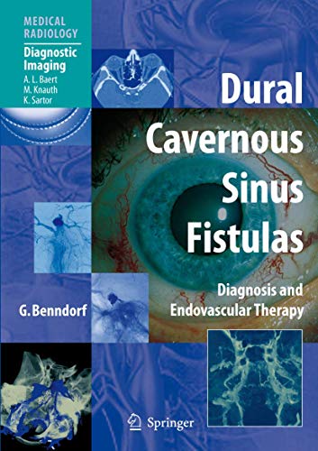 Dural Cavernous Sinus Fistulas: Diagnosis and Endovascular Therapy (Medical Radiology)